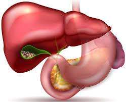 Cholelithiasis